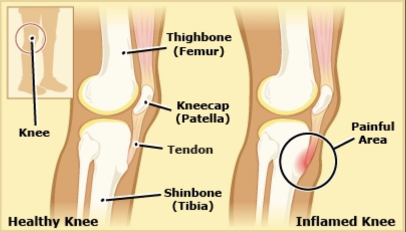 Osgood-Schlatter's Disease